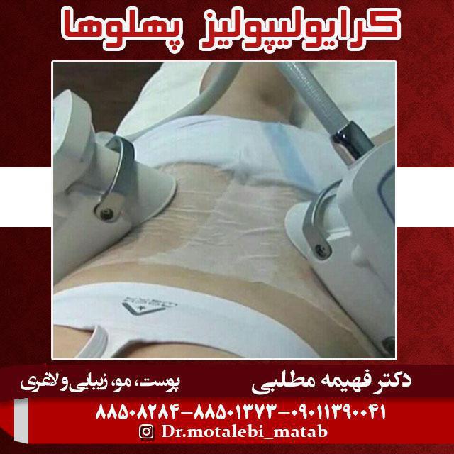 کرایولیپولیز - دکتر فهیمه مطلبی