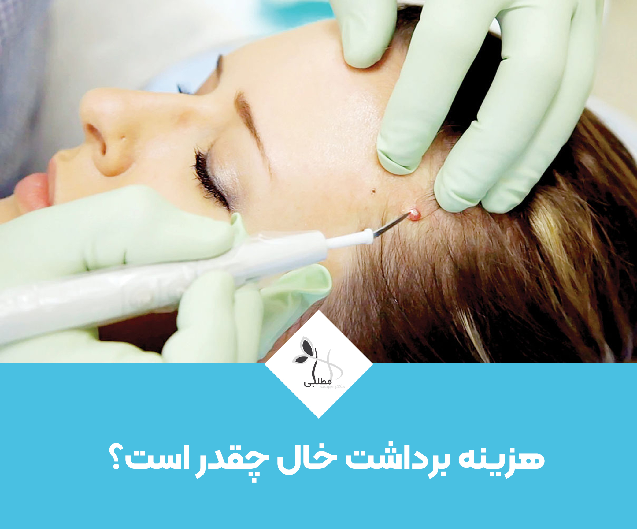 هزینه برداشت خال - دکتر فهیمه مطلبی - روش های مختلف برداشتن خال