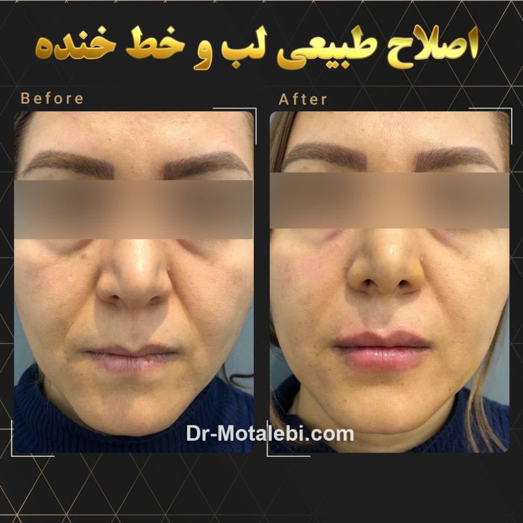 مزوتراپی اصلاح خط لب و خنده | دکتر مطلبی