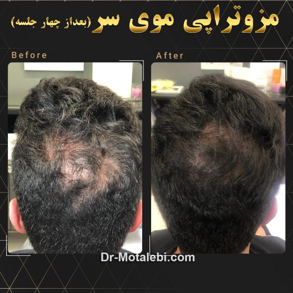 مزوتراپی موی سر | دکتر مطلبی