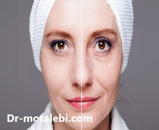 لیفت صورت چیست و چگونه انجام میشود؟ - کلینیک دکتر فهیمه مطلبی