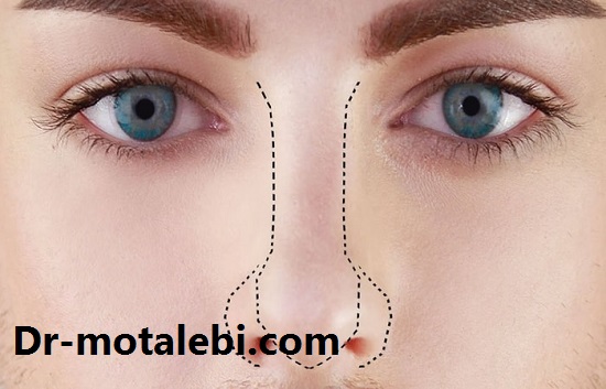 ماندگاری پلاسمای بینی چقدر است؟ - دکتر مطلبی