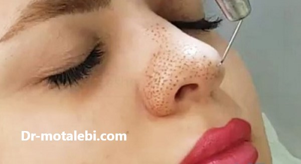پلاسمای بینی توسط دکتر فهیمه مطلبی