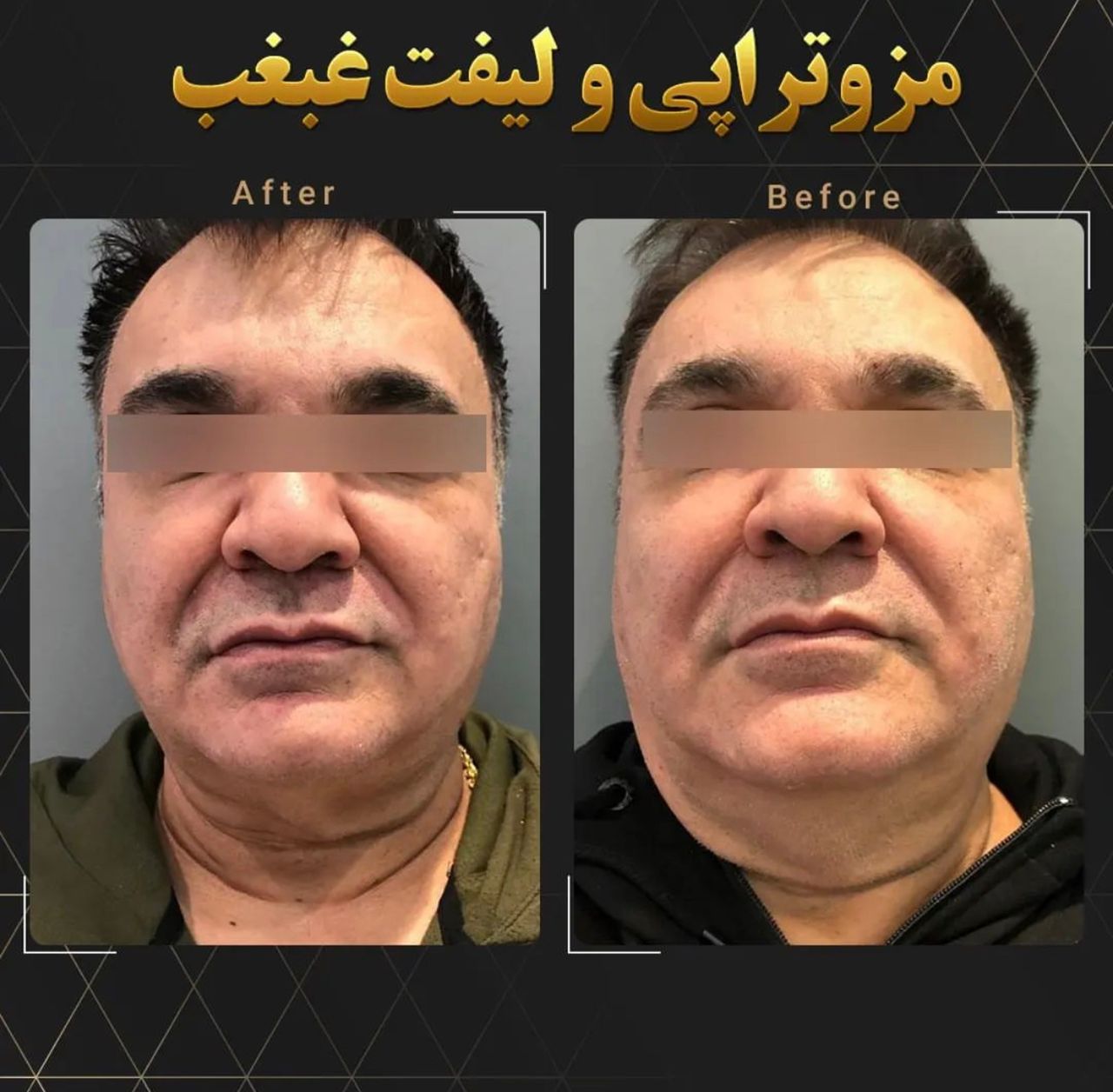 مزوتراپی لاغری غبغب مزوتراپی لاغری غبغب