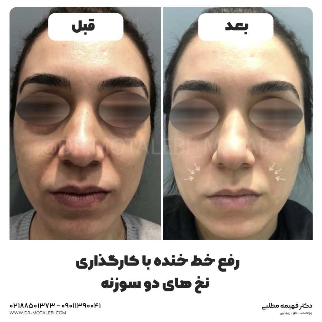 درمان خط خنده باکارگذاری نخ جوانسازی